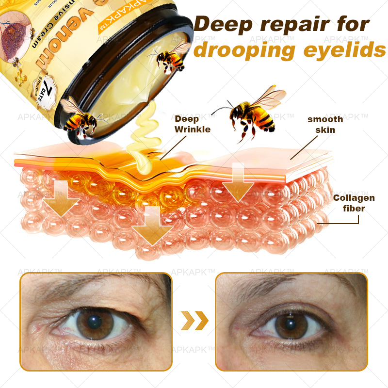 APKAPK⢠Bee Venom Skin Treatment Cream, Anti-aging, Hydrating, Skin Repair, Even Tone, Acne and Dark Spot Treatment, Wart and Mole Removal, Psoriasis Relief