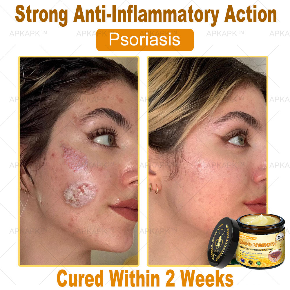 APKAPK⢠Bee Venom Skin Treatment Cream, Anti-aging, Hydrating, Skin Repair, Even Tone, Acne and Dark Spot Treatment, Wart and Mole Removal, Psoriasis Relief