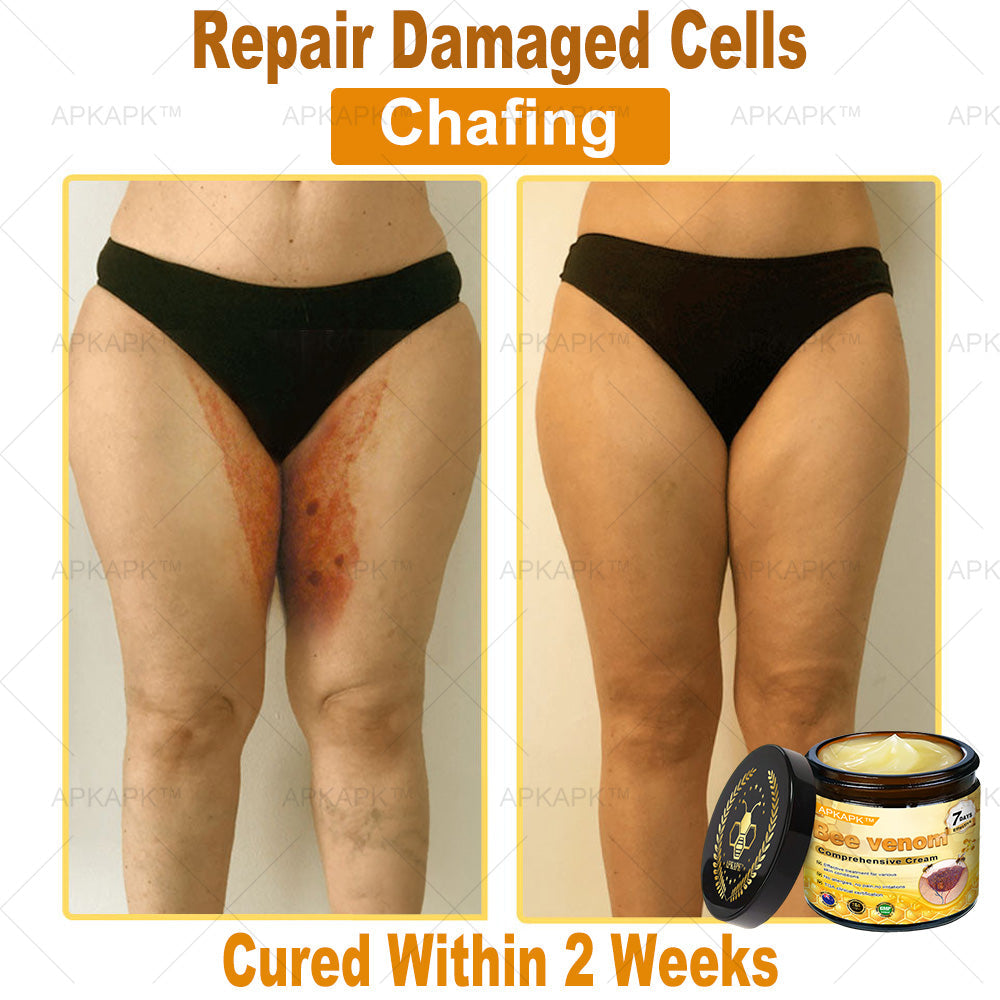 APKAPK⢠Bee Venom Skin Treatment Cream, Anti-aging, Hydrating, Skin Repair, Even Tone, Acne and Dark Spot Treatment, Wart and Mole Removal, Psoriasis Relief