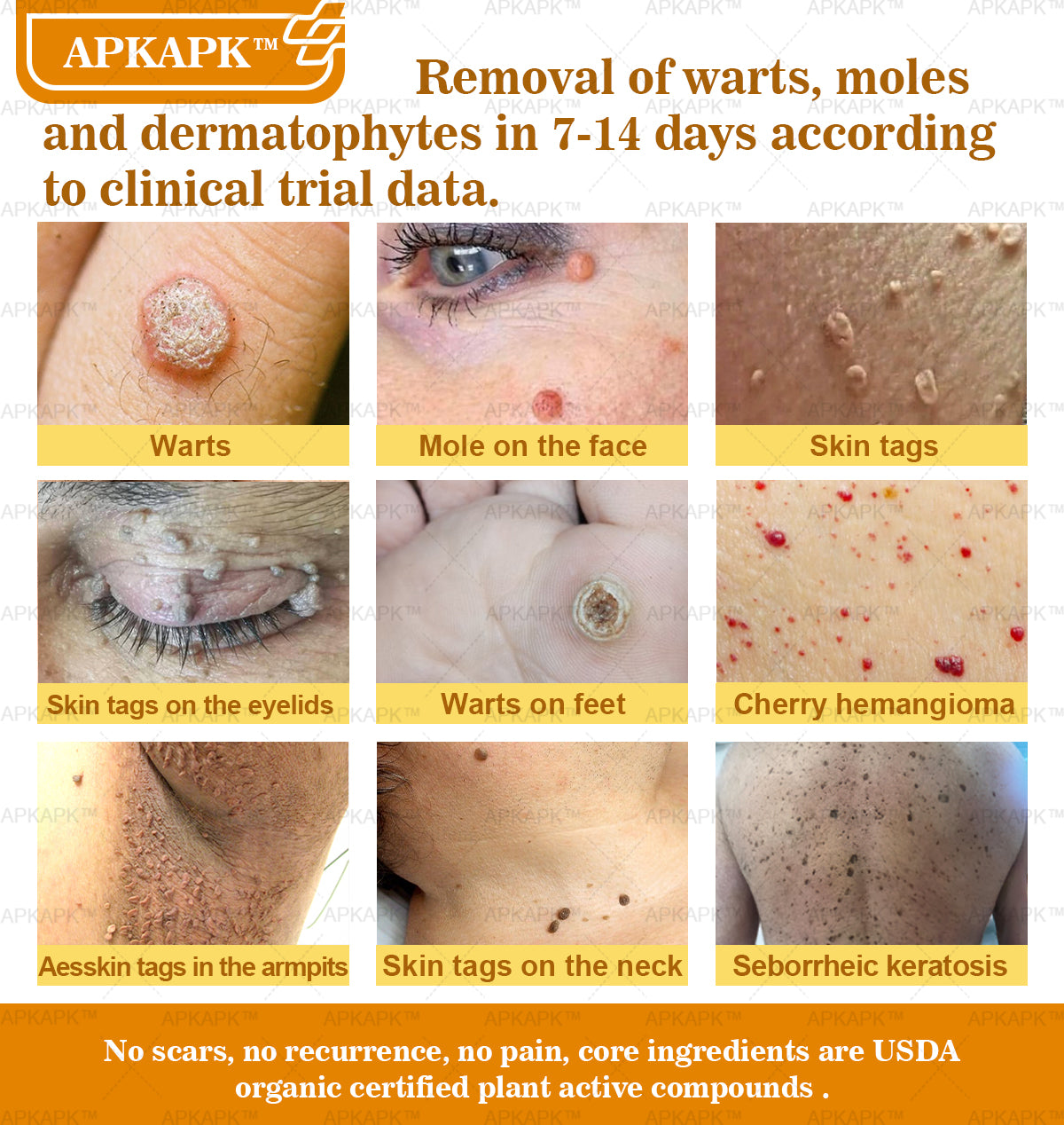 APKAPK⢠Bee Venom Skin Treatment Cream, Anti-aging, Hydrating, Skin Repair, Even Tone, Acne and Dark Spot Treatment, Wart and Mole Removal, Psoriasis Relief