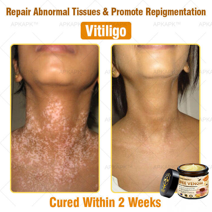 ๐๐๐๐๐๐โข Bee Venom Comprehensive Cream (Suitable for all ages & TGA recommends)๐ฅ๐ฅ