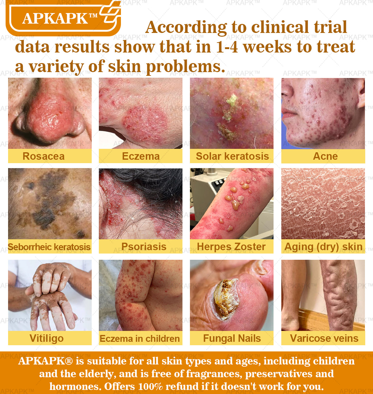 APKAPK⢠Bee Venom Skin Treatment Cream, Anti-aging, Hydrating, Skin Repair, Even Tone, Acne and Dark Spot Treatment, Wart and Mole Removal, Psoriasis Relief