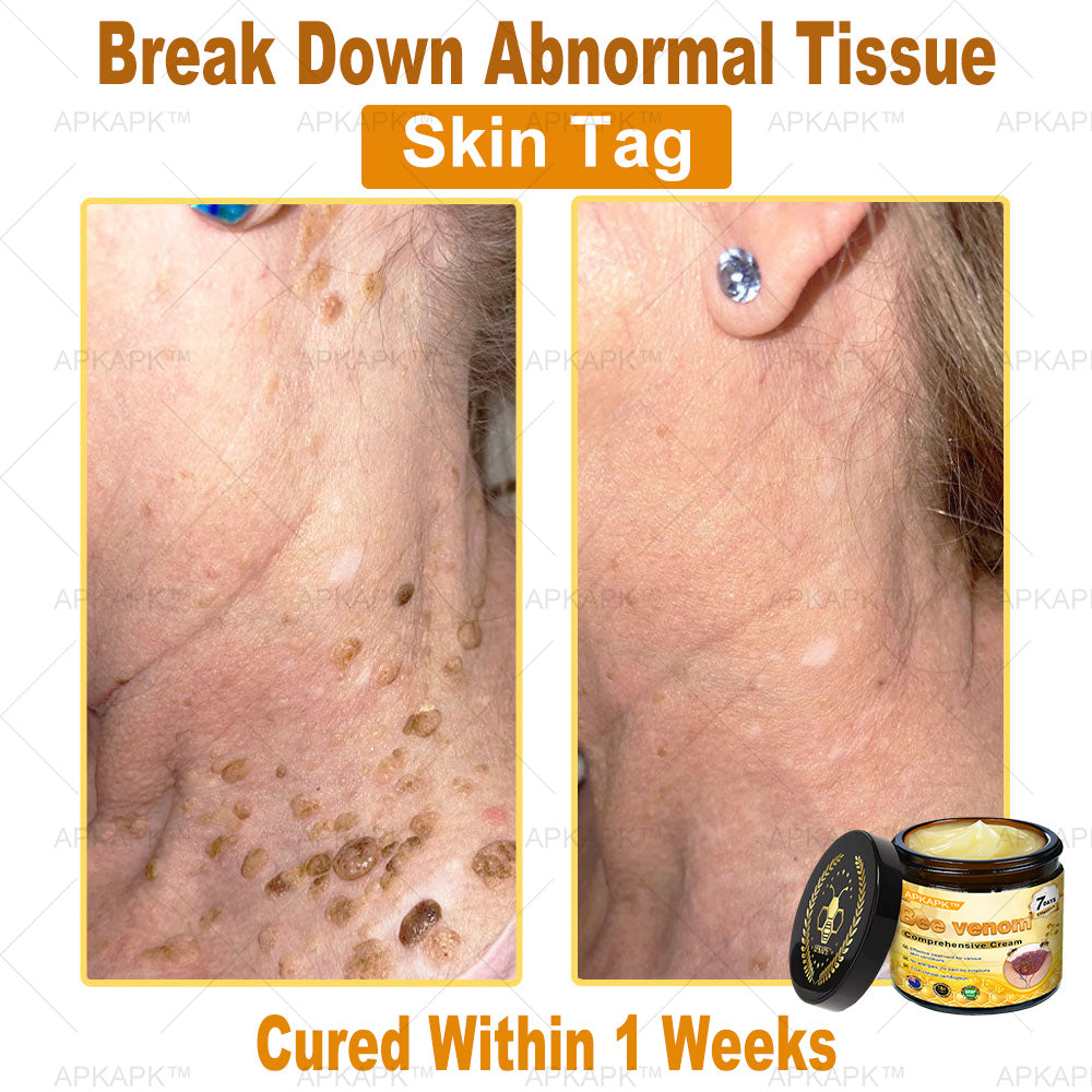 APKAPK⢠Bee Venom Skin Treatment Cream, Anti-aging, Hydrating, Skin Repair, Even Tone, Acne and Dark Spot Treatment, Wart and Mole Removal, Psoriasis Relief