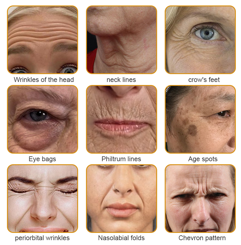 APKAPK⢠Bee Venom Skin Treatment Cream, Anti-aging, Hydrating, Skin Repair, Even Tone, Acne and Dark Spot Treatment, Wart and Mole Removal, Psoriasis Relief