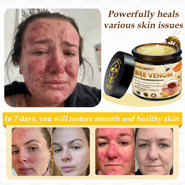 ๐๐๐๐๐๐โข Bee Venom Comprehensive Cream (Suitable for all ages & TGA recommends)๐ฅ๐ฅ