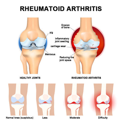 👑👑LIPOGO™ Bee Venom & Turmeric Arthritis Treatment Cream (👩‍🔬Specialized in Orthopedic Conditions and Joint Pain👩‍🔬)