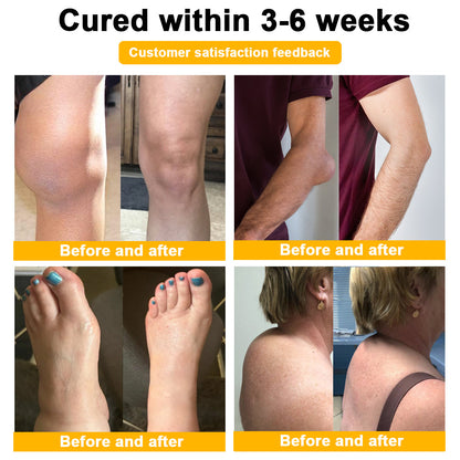 👑👑LIPOGO™ Bee Venom & Turmeric Arthritis Treatment Cream (👩‍🔬Specialized in Orthopedic Conditions and Joint Pain👩‍🔬)