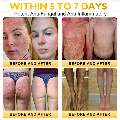 𝐀𝐏𝐊𝐀𝐏𝐊™ Bee Venom Comprehensive Cream (Suitable for all ages & TGA recommends)🔥🔥