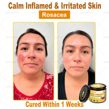APKAPK™ Bee Venom Skin Treatment Cream, Anti-aging, Hydrating, Skin Repair, Even Tone, Acne and Dark Spot Treatment, Wart and Mole Removal, Psoriasis Relief